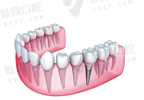 数字化3d打印导板种植牙