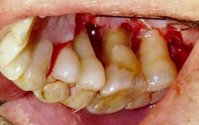 重度牙周炎的牙一定要拔吗？