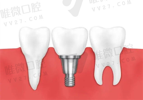 种植牙质量