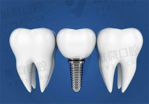 郑州植得口腔医院种牙技术