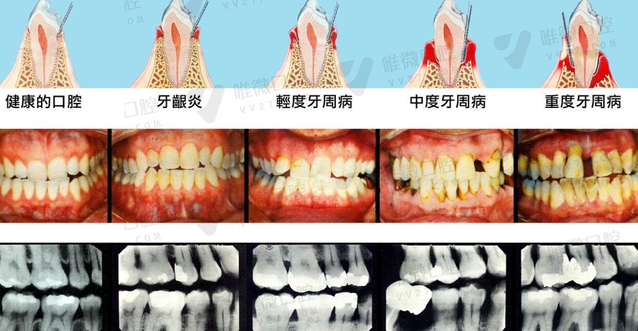 什么是牙周疾病