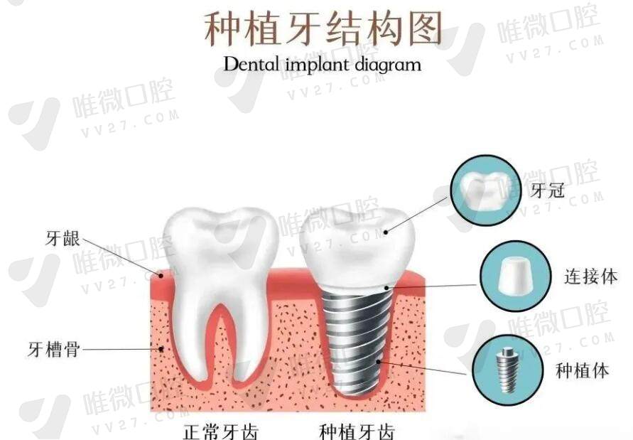 全口即刻负重术式的优点是什么