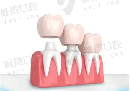 影响全瓷牙价格的因素：