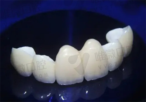 好用性价比高的全瓷牙怎么选择呢