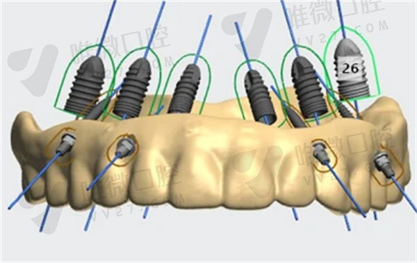 种植牙导板是干什么用的？