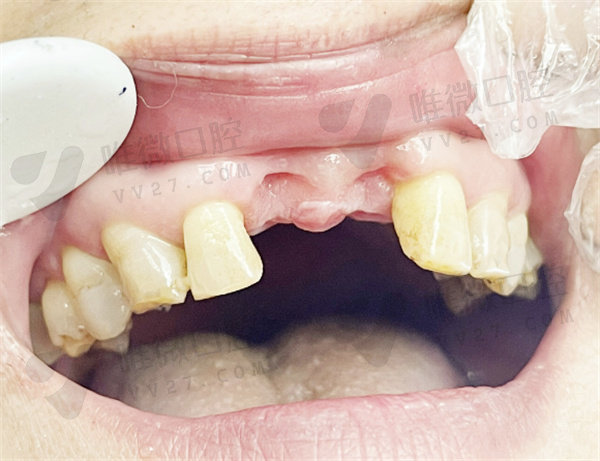 纯钛支架活动假牙