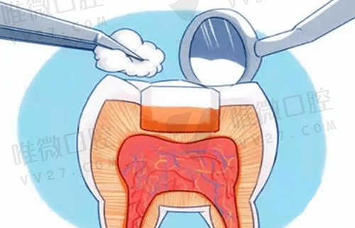 补牙用什么材料好