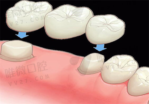 种植牙牙根与骨结合，无法移动的