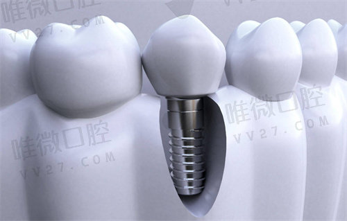 华西口腔医院种植牙技术怎样