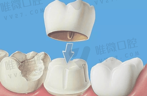 带牙冠的过程痛苦吗