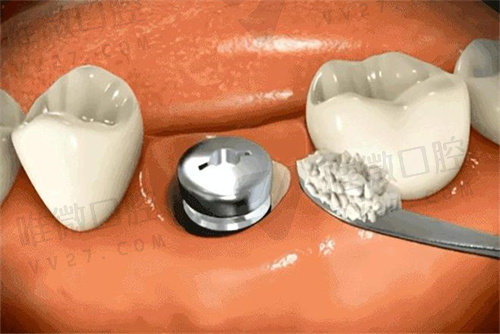 种植牙植骨和不植骨的区别