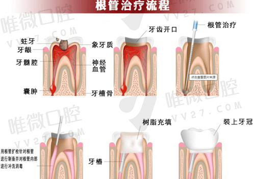 根管治疗后必须做牙冠吗