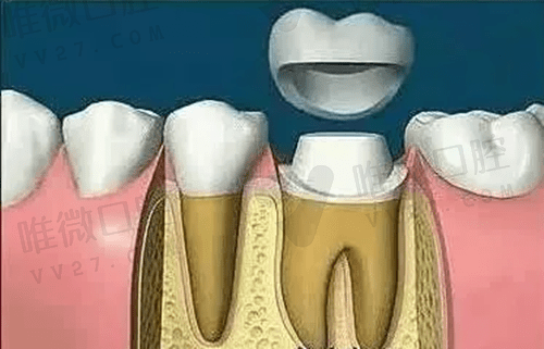 根管治疗后必须做牙冠吗