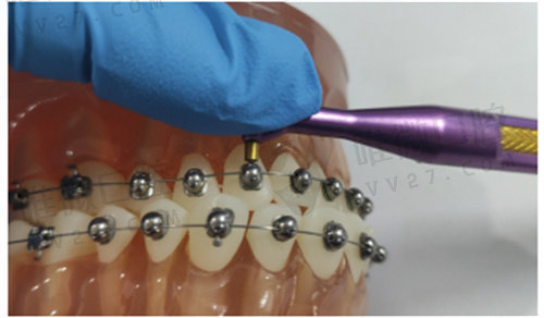 obrace球面自锁托槽矫牙更方便