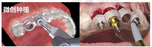 微创种植牙的全部过程