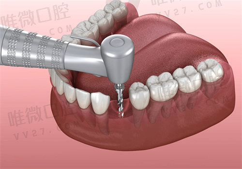 微创种植牙不痛苦出血少