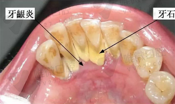 龈下刮治后牙龈会重新包紧牙吗？