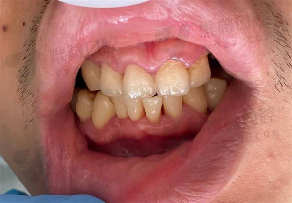 龈下刮治后牙龈会重新包紧牙吗？
