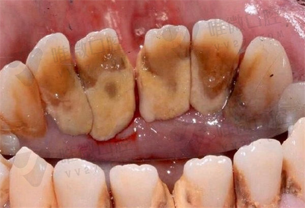 龈下刮治后牙齿松动会恢复吗？