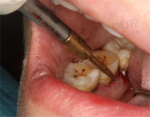 龈下刮治后牙齿松动会恢复吗？