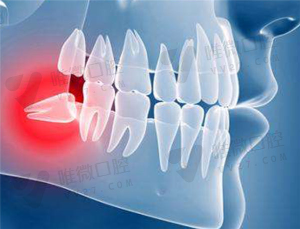 医生为什么建议四颗智齿都拔