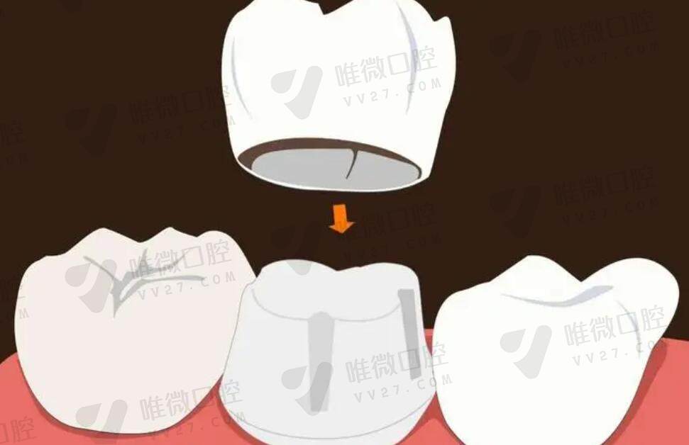 美加全瓷牙冠多少钱一颗