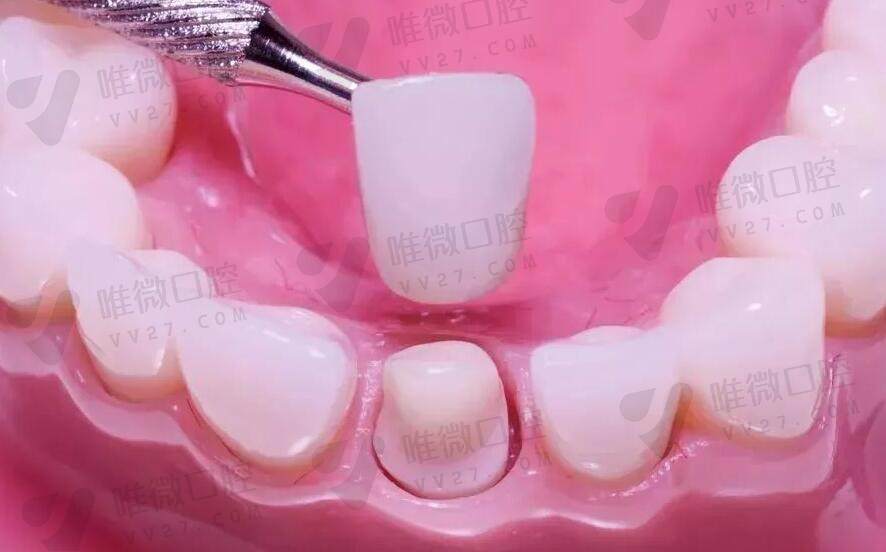 美晶瓷全瓷牙多少钱一颗