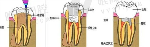 显微根管的步骤