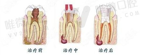显微根管治疗术是什么意思
