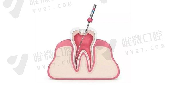 显微根管治疗价格