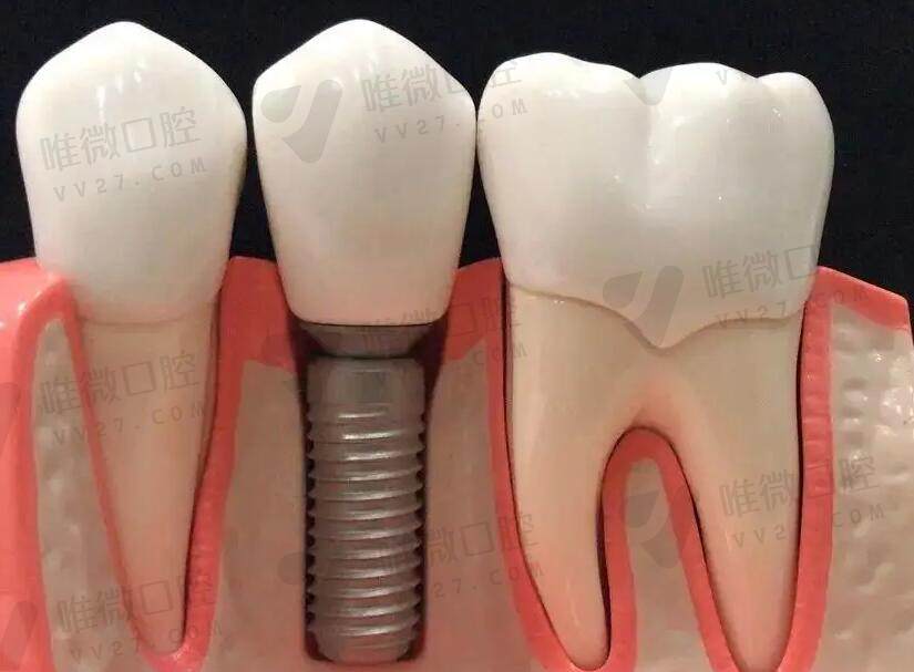 老牙医不建议做种植牙的原因