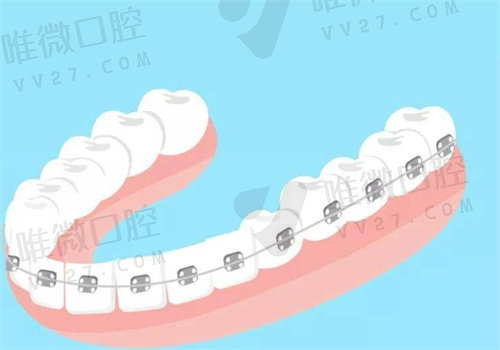 二次矫正比头一次更贵吗？