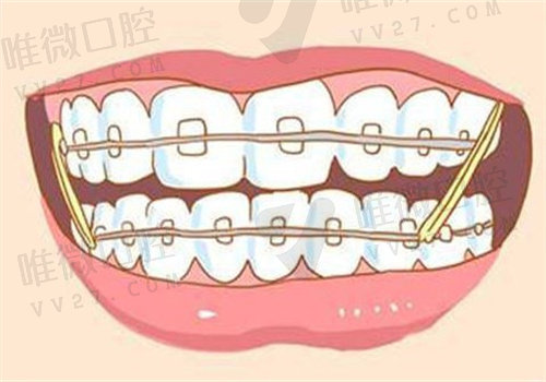 二次矫正比头一次更贵吗？