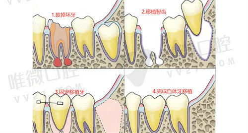 自体牙移植和种植牙的区别