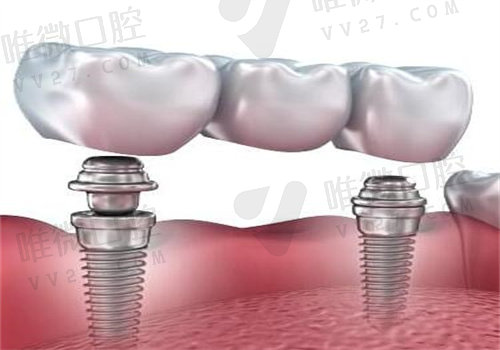 哈尔滨全口种植牙价格