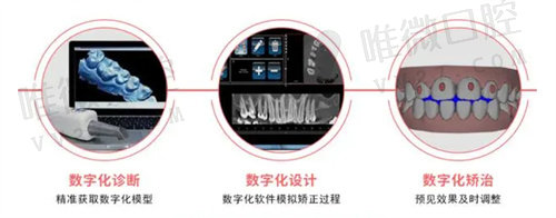 数字化美学矫正的三个重要步骤