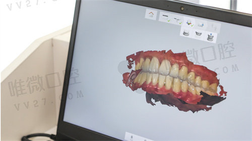 美学矫正的3D数字化口腔模型