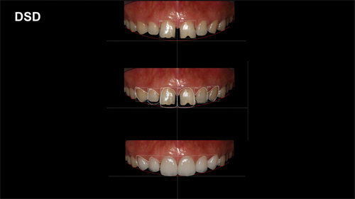 DSD微笑美学设计牙齿矫正
