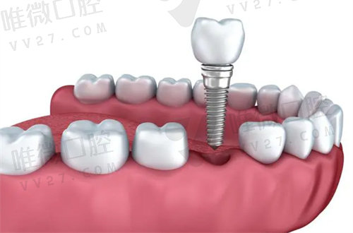 长春哪家口腔医院种植牙技术好又便宜
