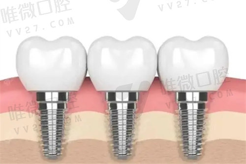长春全口种植牙多少钱