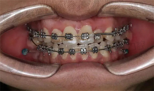 遗传性龅牙几岁可以矫正？