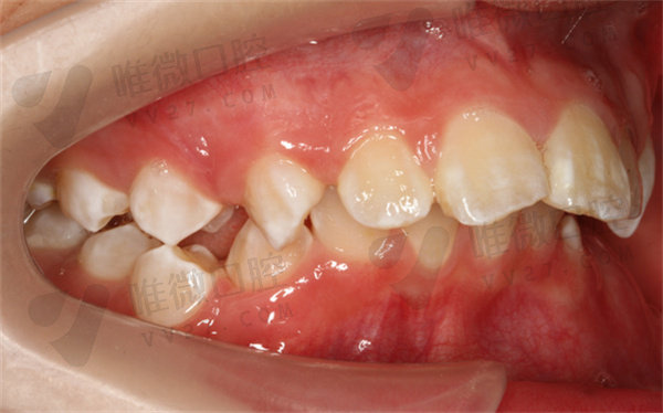 遗传性龅牙矫正会反弹吗？