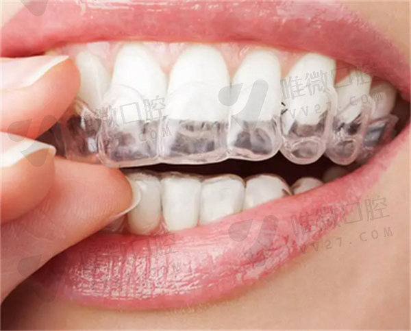 遗传性龅牙矫正会反弹吗？