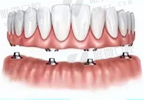 半口牙缺失好的治疗方案