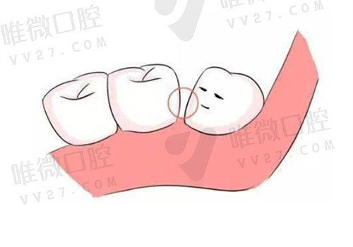 为什么牙医都不愿意补牙缝