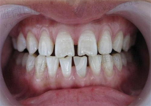 为什么牙医都不愿意补牙缝