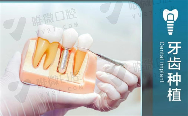 天津中诺口腔医院种植牙价格