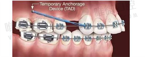牙齿矫正可以改善地包天吗