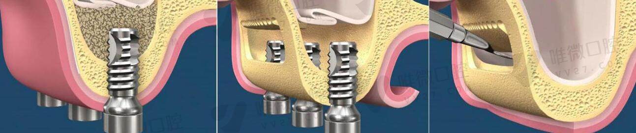 上颌窦提升种牙术后注意事项