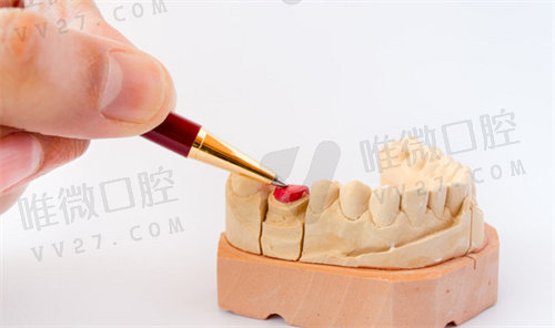 广州种植牙集采新消息